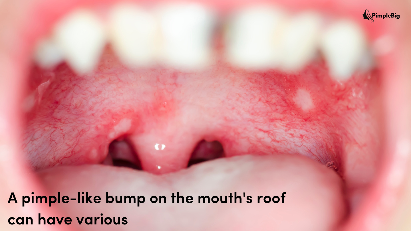 pimple-on-roof-of-mouth-causes-treatments-tips