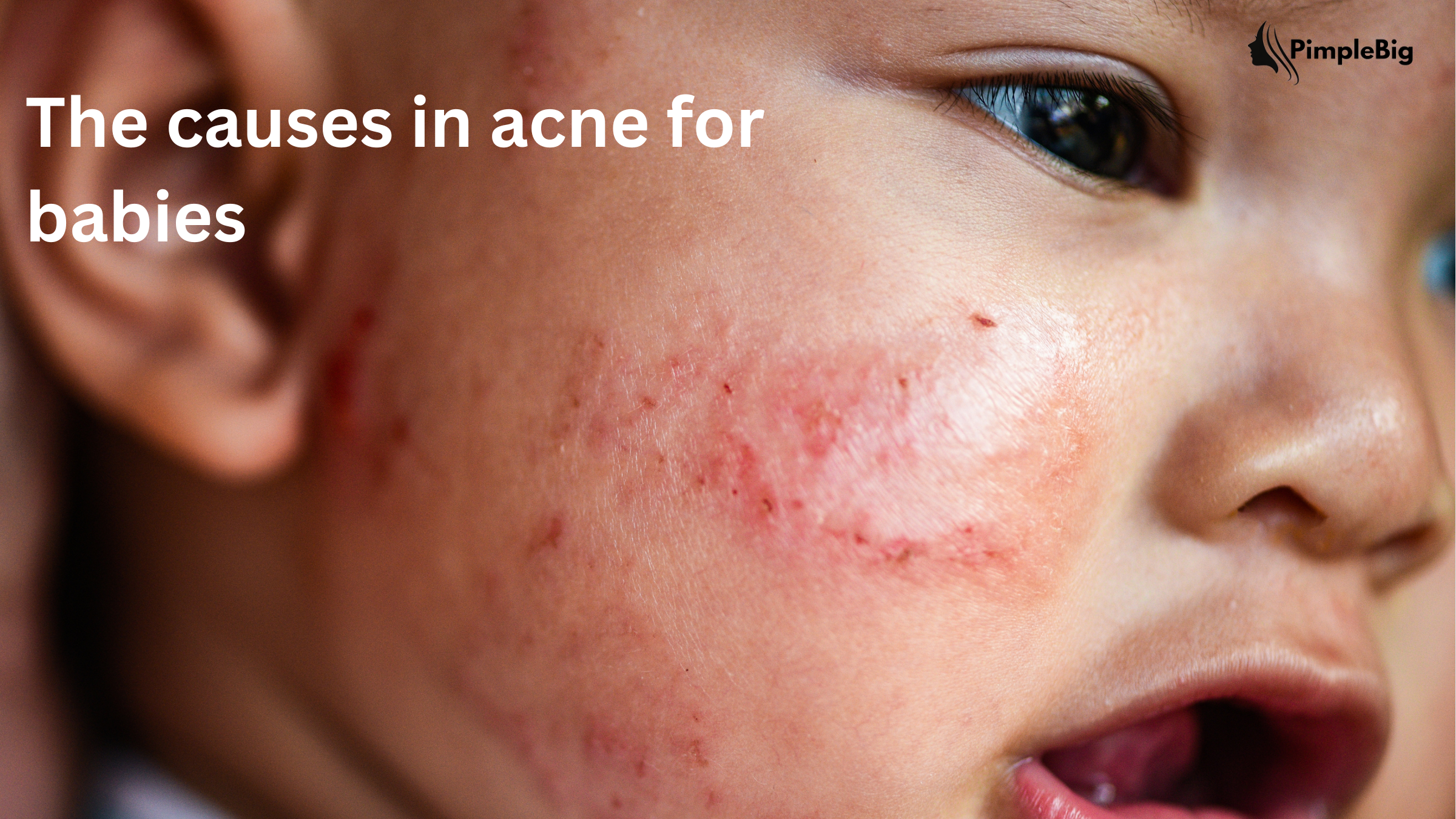 Acne On Baby Skin